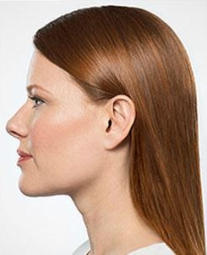 Kybella - Destroys fat cells under the chin